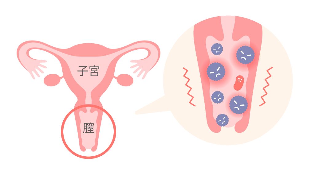 乱れた膣内環境で悪玉菌が増殖するイメージ
